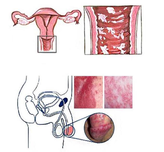 Genital candidiasis in men and women is the cause of the disease