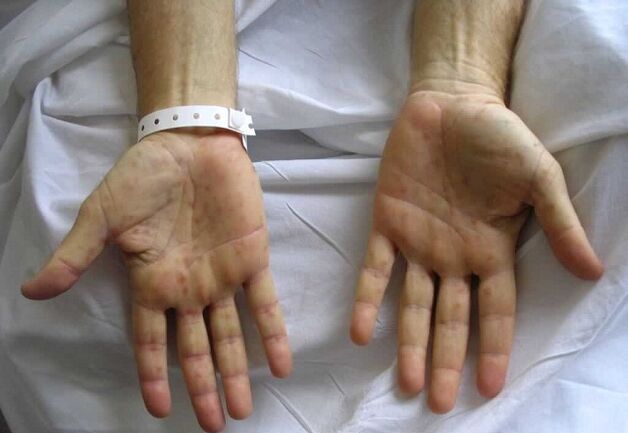 Syphilis in the hands is the cause of pathological discharge from the penis